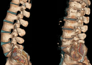 low back pain