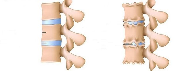 Healthy spine and osteochondrosis
