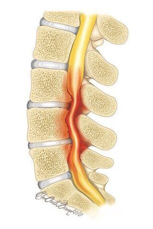 With thoracic osteochondrosis, spinal canal compression