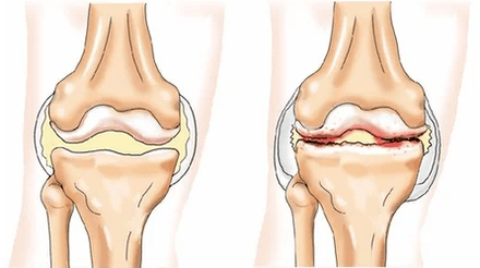Cartilage disease