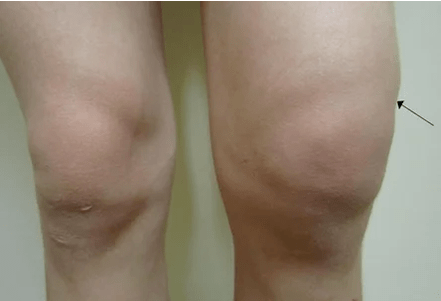 Hematoma in the knee joint