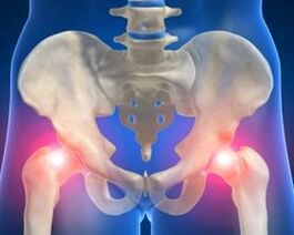 Causes of hip joint articulation
