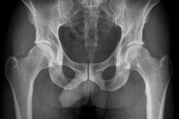 Diagnostic choices for hip arthritis