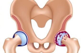 The development stage of hip arthritis