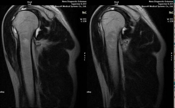 X-ray diagnosis of shoulder joint