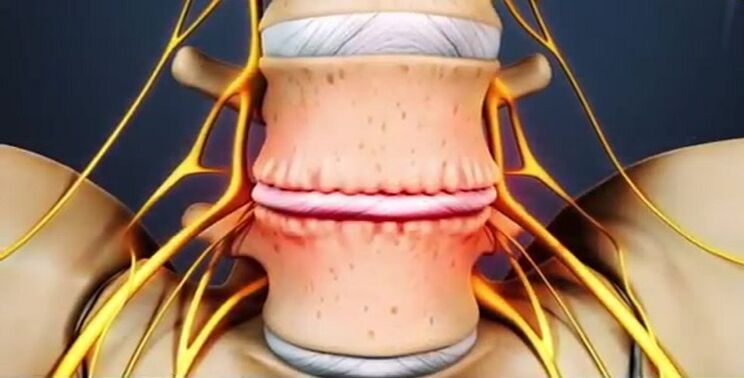 Spinal injuries caused by osteochondrosis