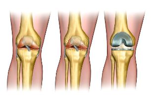 the degree of osteoarthritis